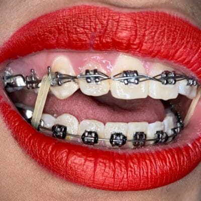 Cassy Braces OnlyFans México - @cassy.braces